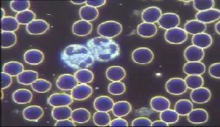 Dark field microscopy of live blood showing separated red cells and a white cell
