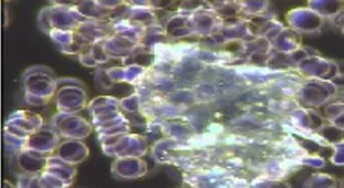 Dark field microscopy showing a pale mass of proteinous waste among red cells