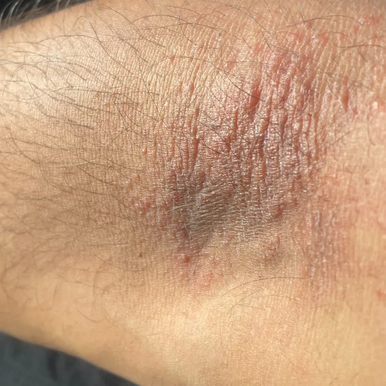 Close view of irritated, inflamed skin on the inner arm