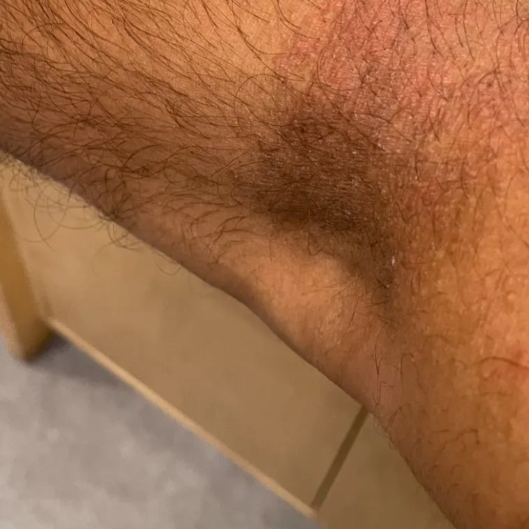 The same area of skin on a different day, with redness and dryness