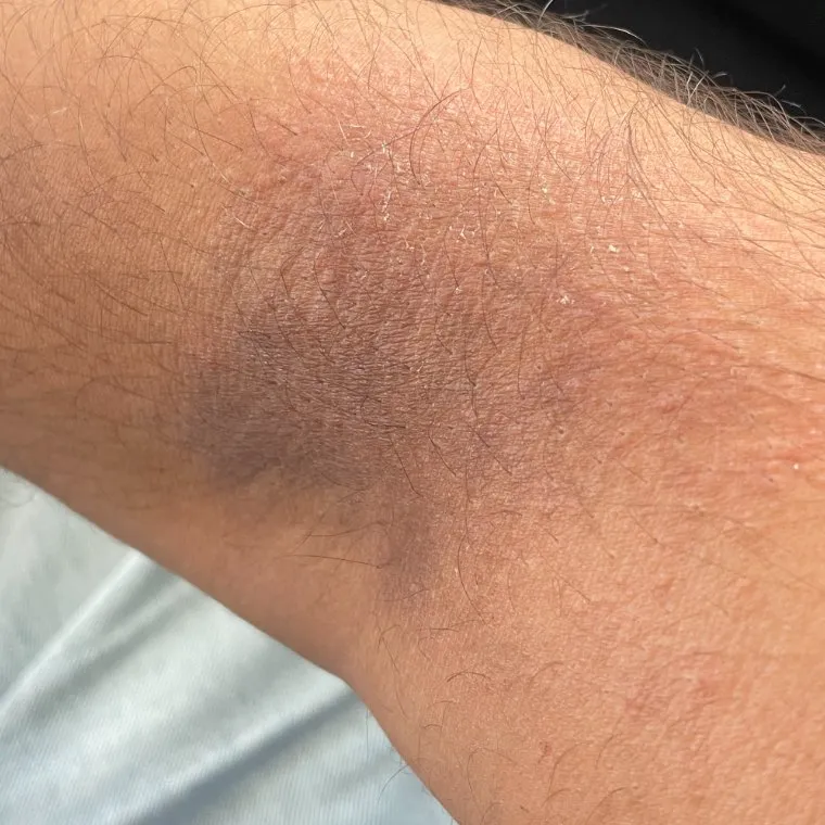 The same area of skin showing dryness and flaking
