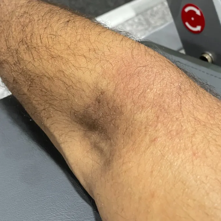 The same area of skin appearing calmer and more even in tone