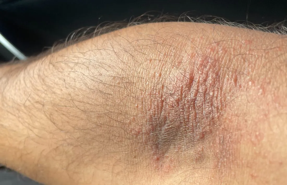 Irritated, inflamed skin on the inner arm